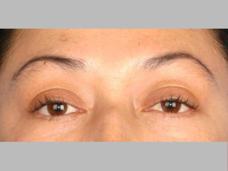 After — Blepharoplasty