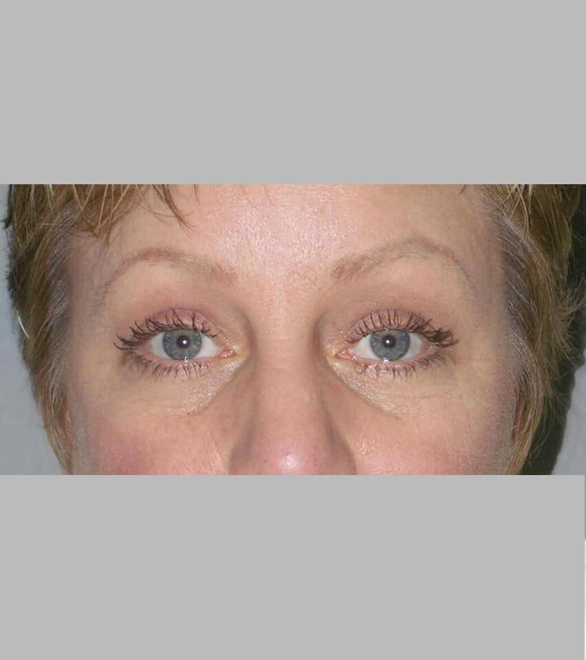 After — Blepharoplasty