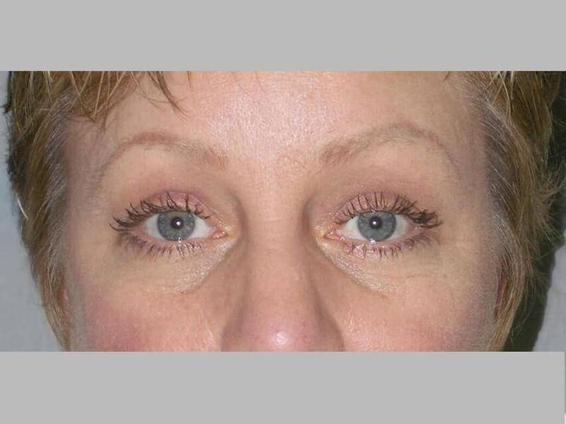 After — Blepharoplasty
