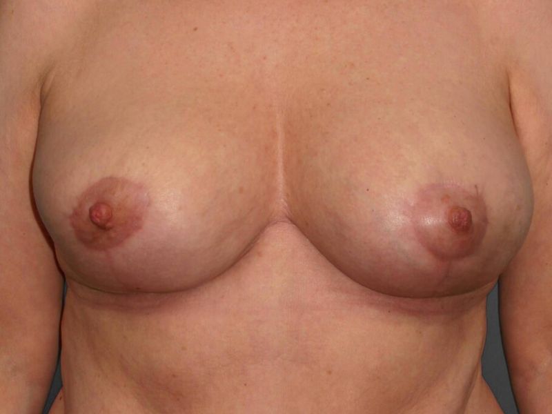 After — Breast Reduction