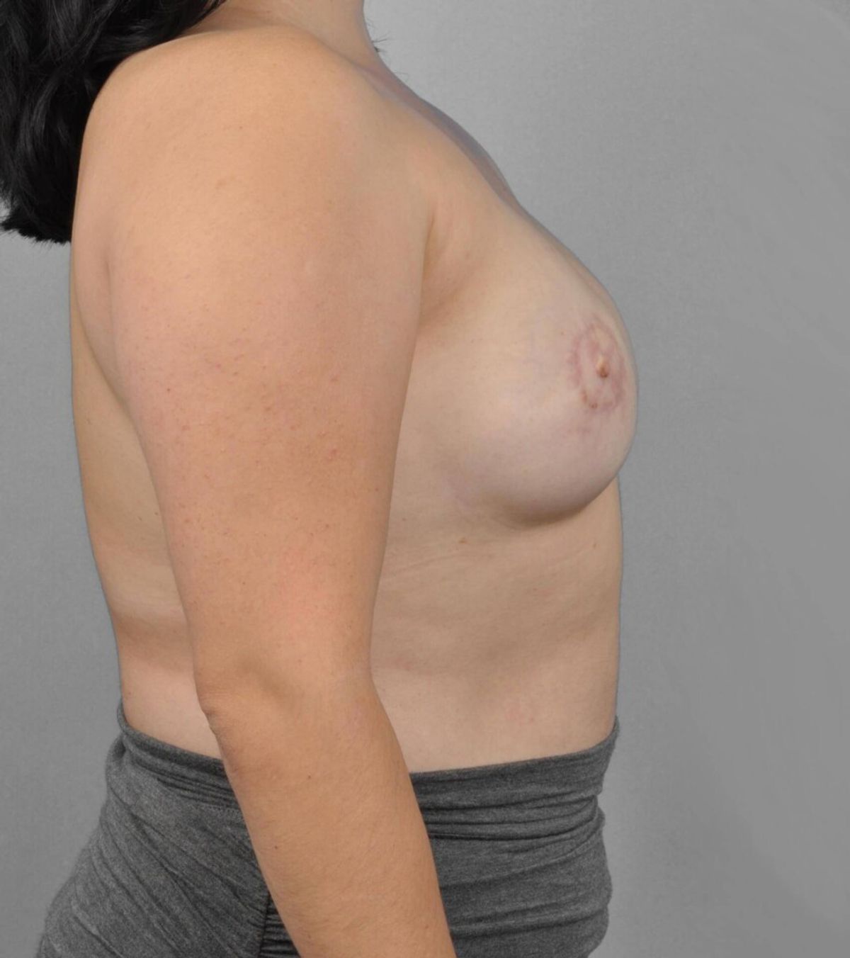 Case 1292 — Oblique after