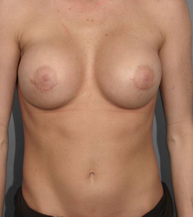 Before — Breast Implant Replacement