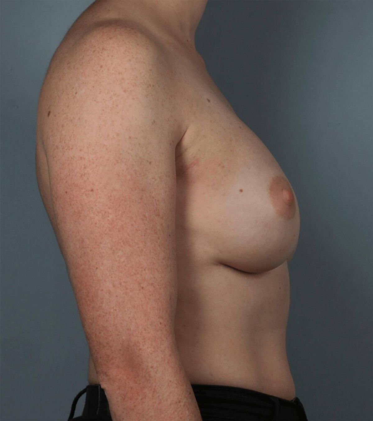 Case 1350 — Oblique after