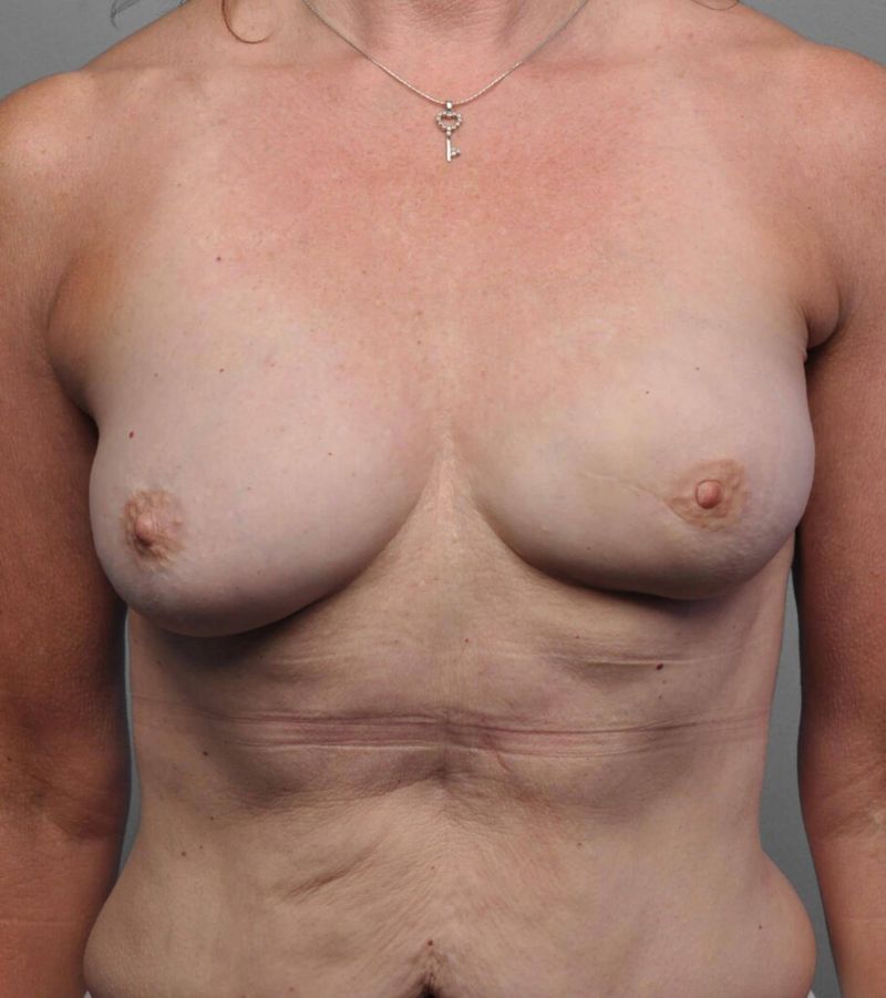 After — Fat Grafting Breast Reconstruction