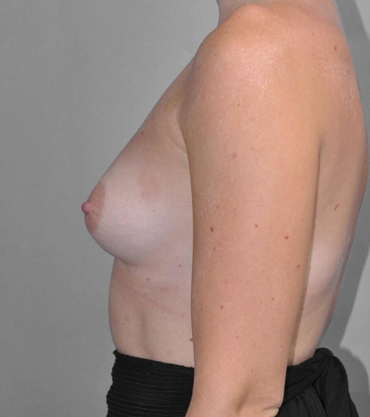 Case 861 — Oblique before
