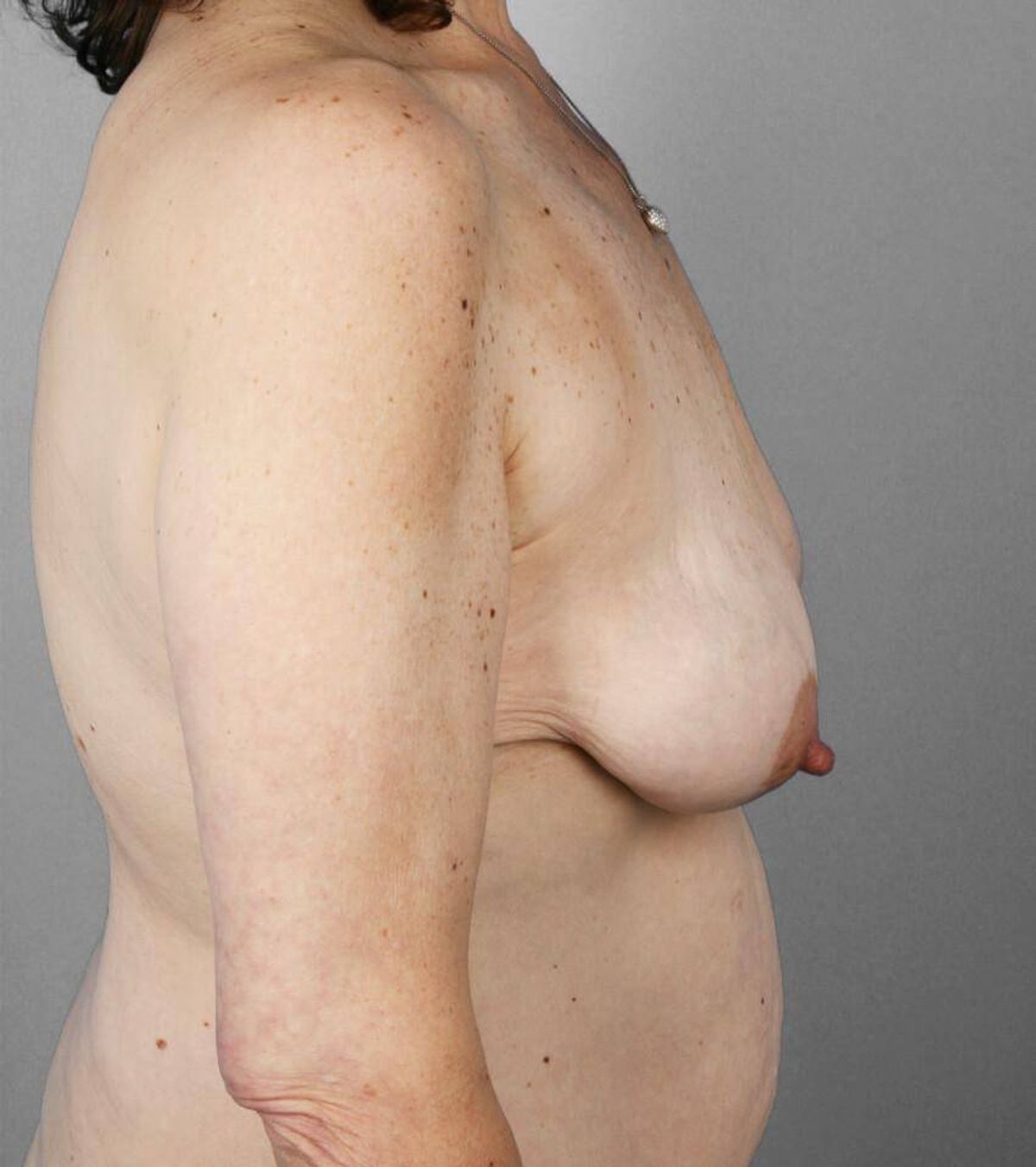 Case 1491 — Oblique before