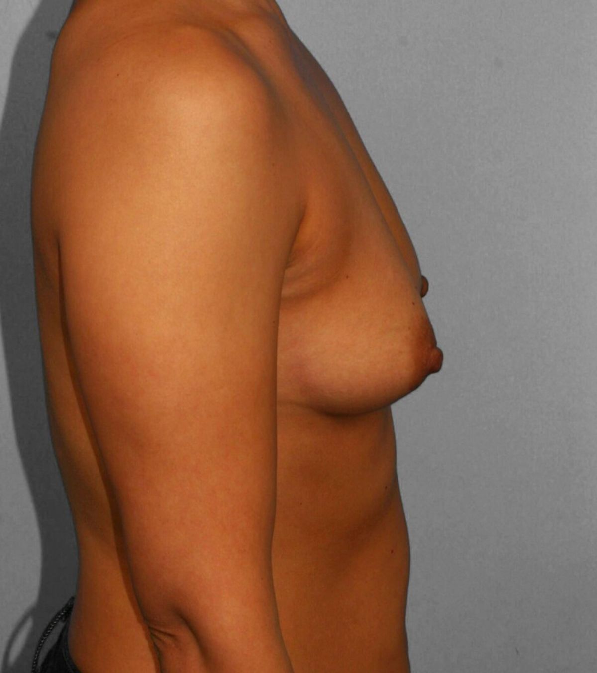 Case 1513 — Oblique before