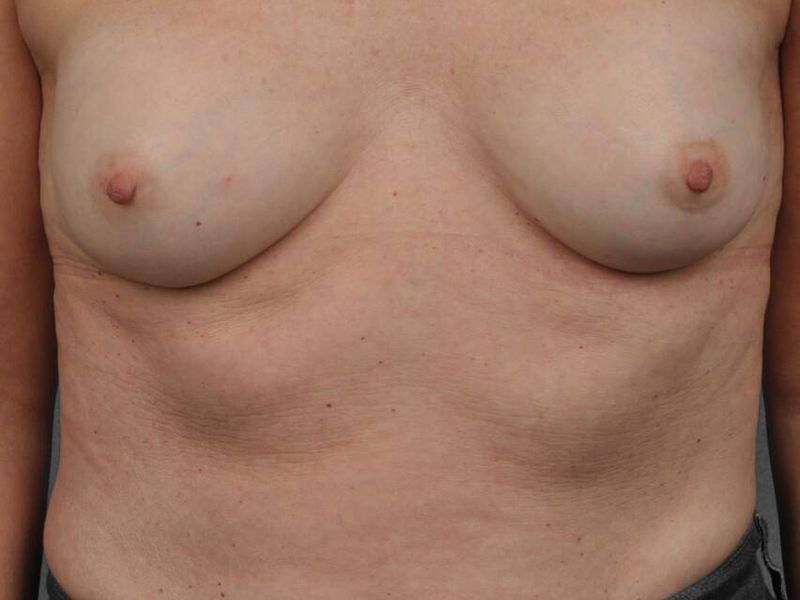 Before — Breast Implant Replacement