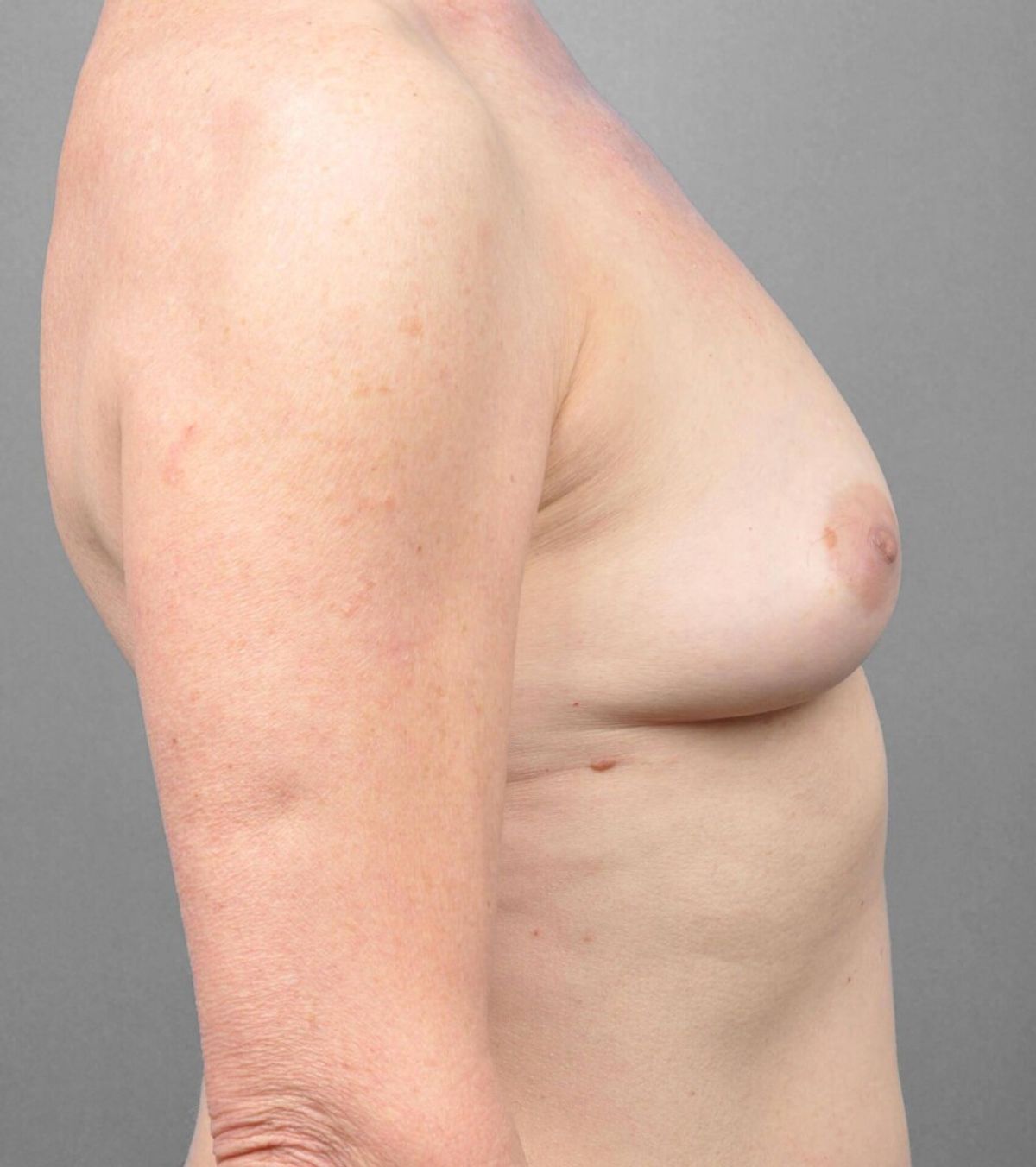 Case 1355 — Oblique after