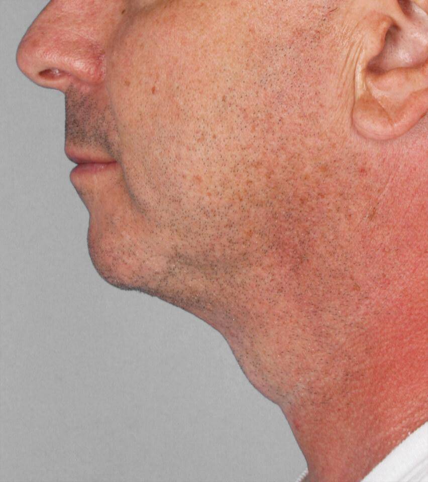 After — Liposuction