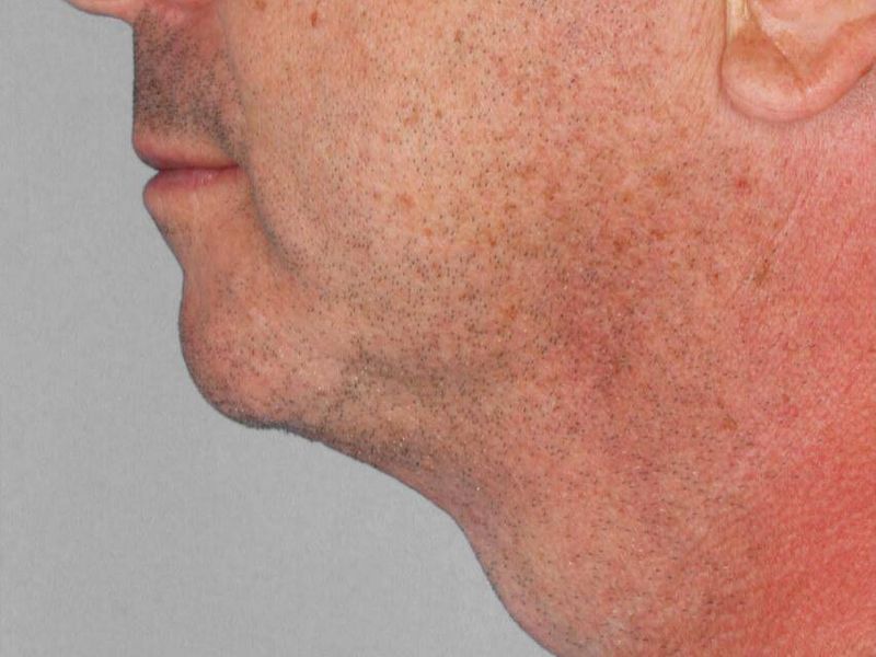 After — Liposuction
