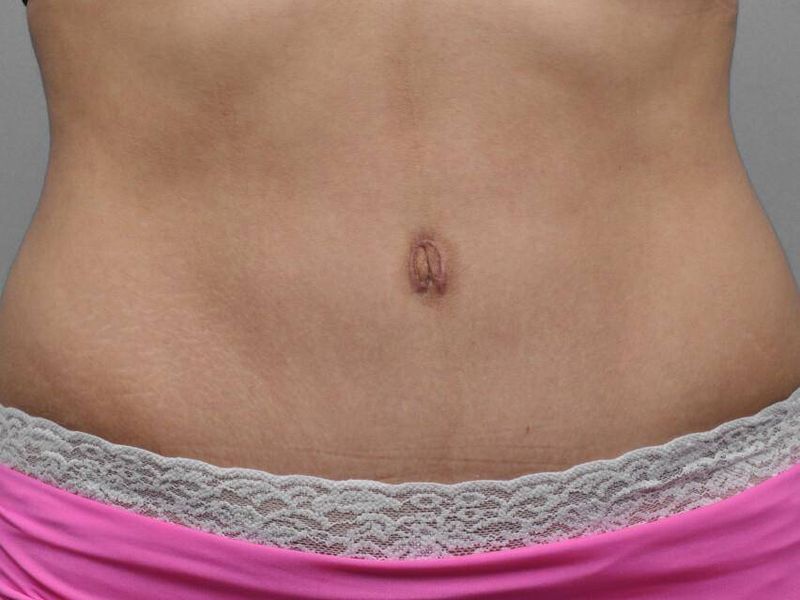 After — Tummy Tuck