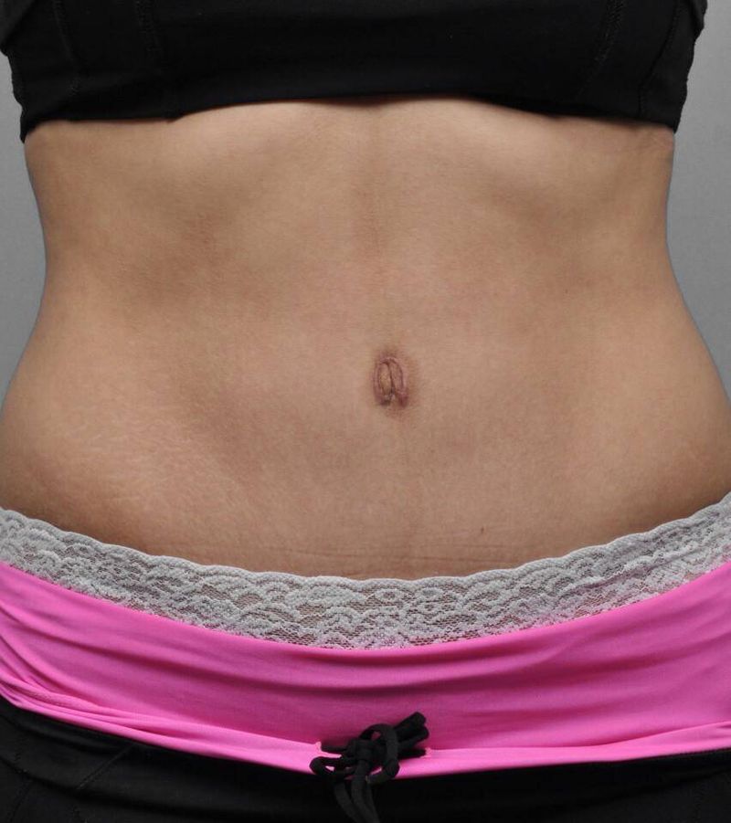 After — Tummy Tuck