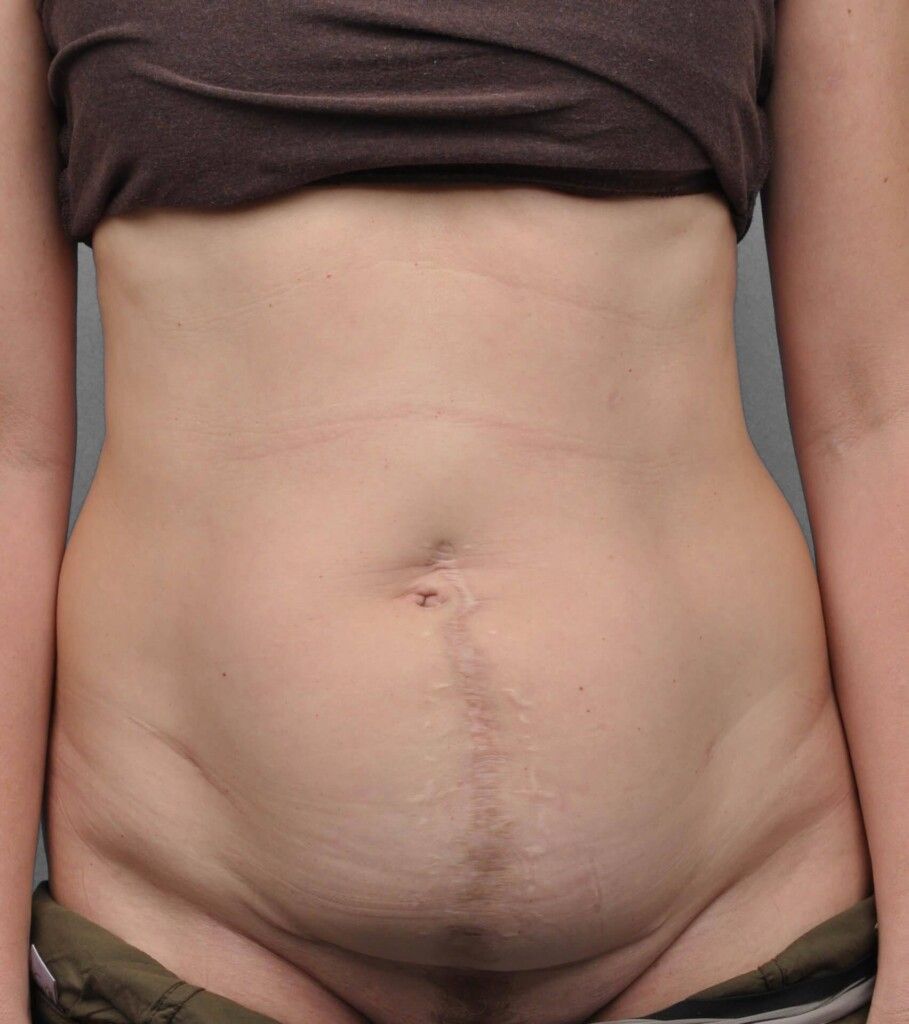 Before — Tummy Tuck
