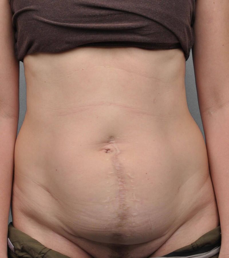 Before — Tummy Tuck