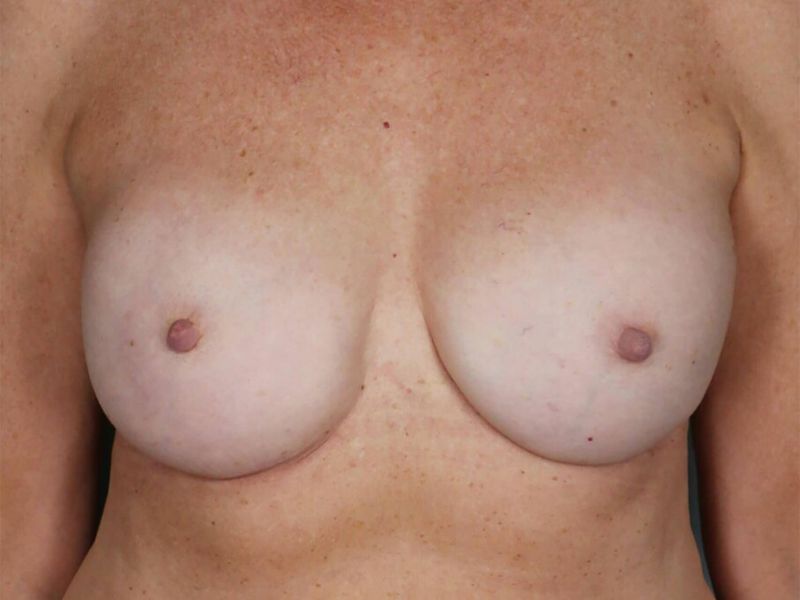 After — Direct-to-Implant Reconstruction
