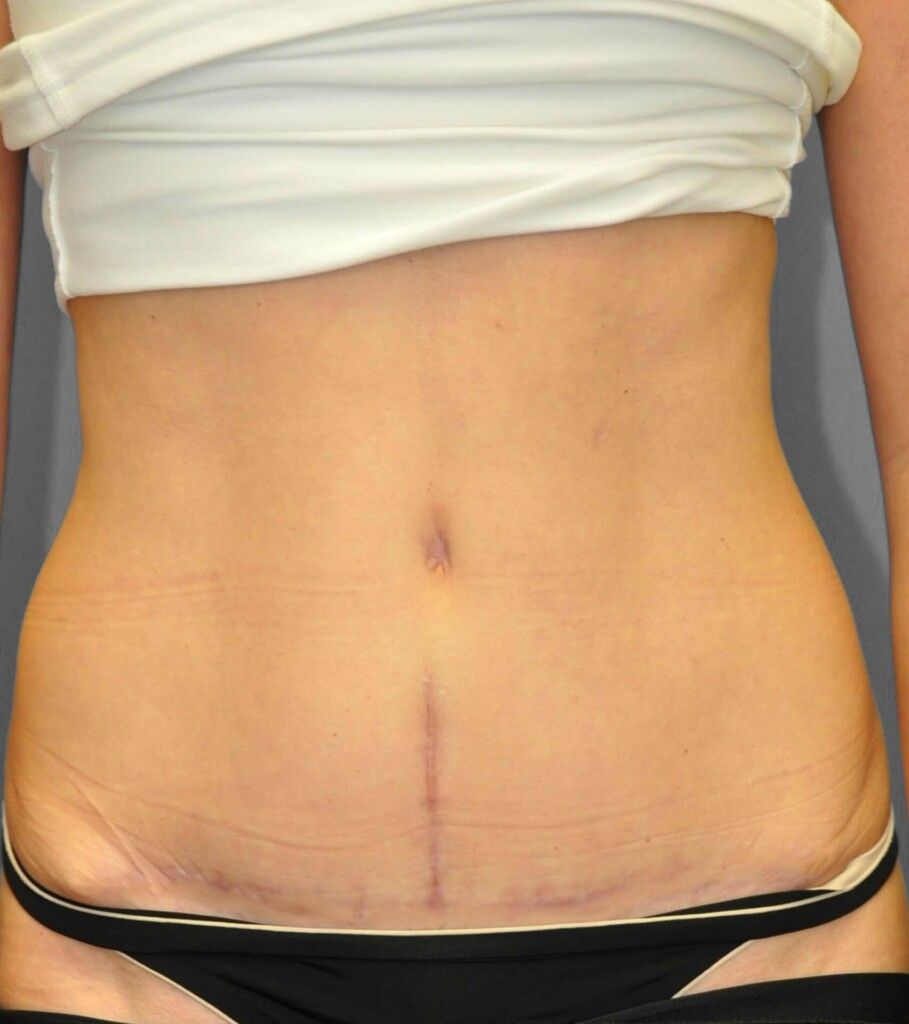 After — Tummy Tuck