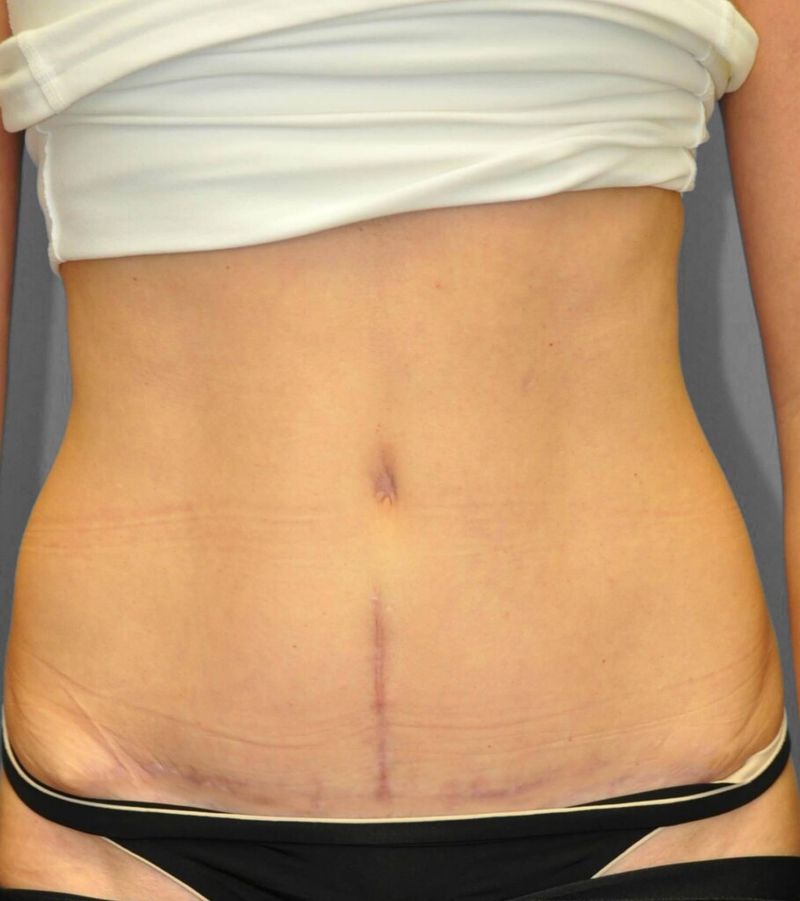 After — Tummy Tuck