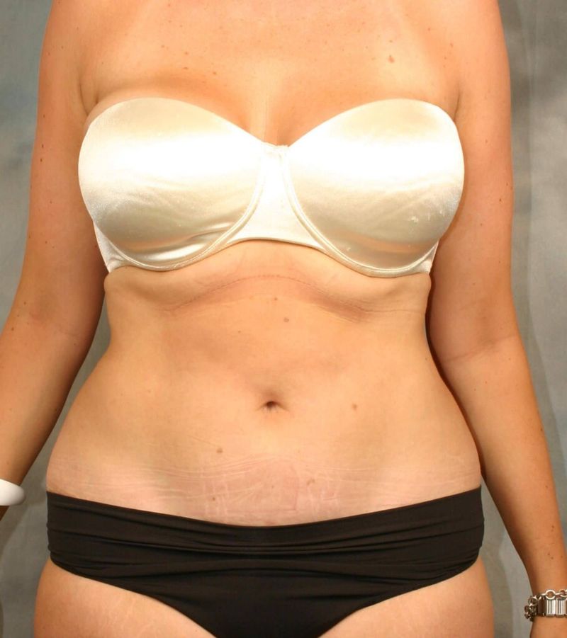 After — Liposuction