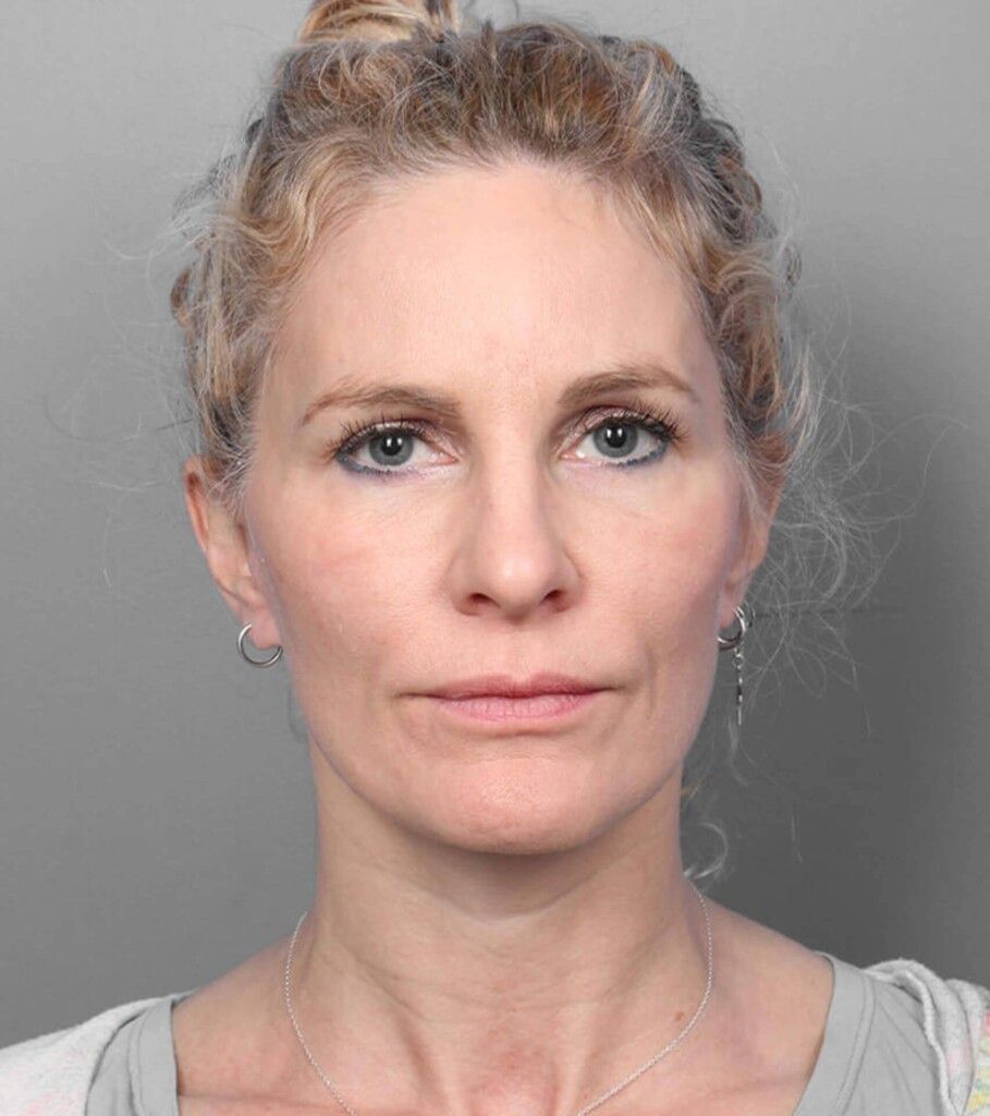 After — Facelift