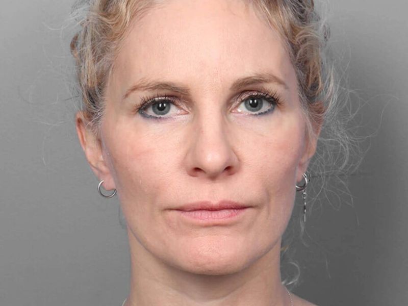 After — Facelift