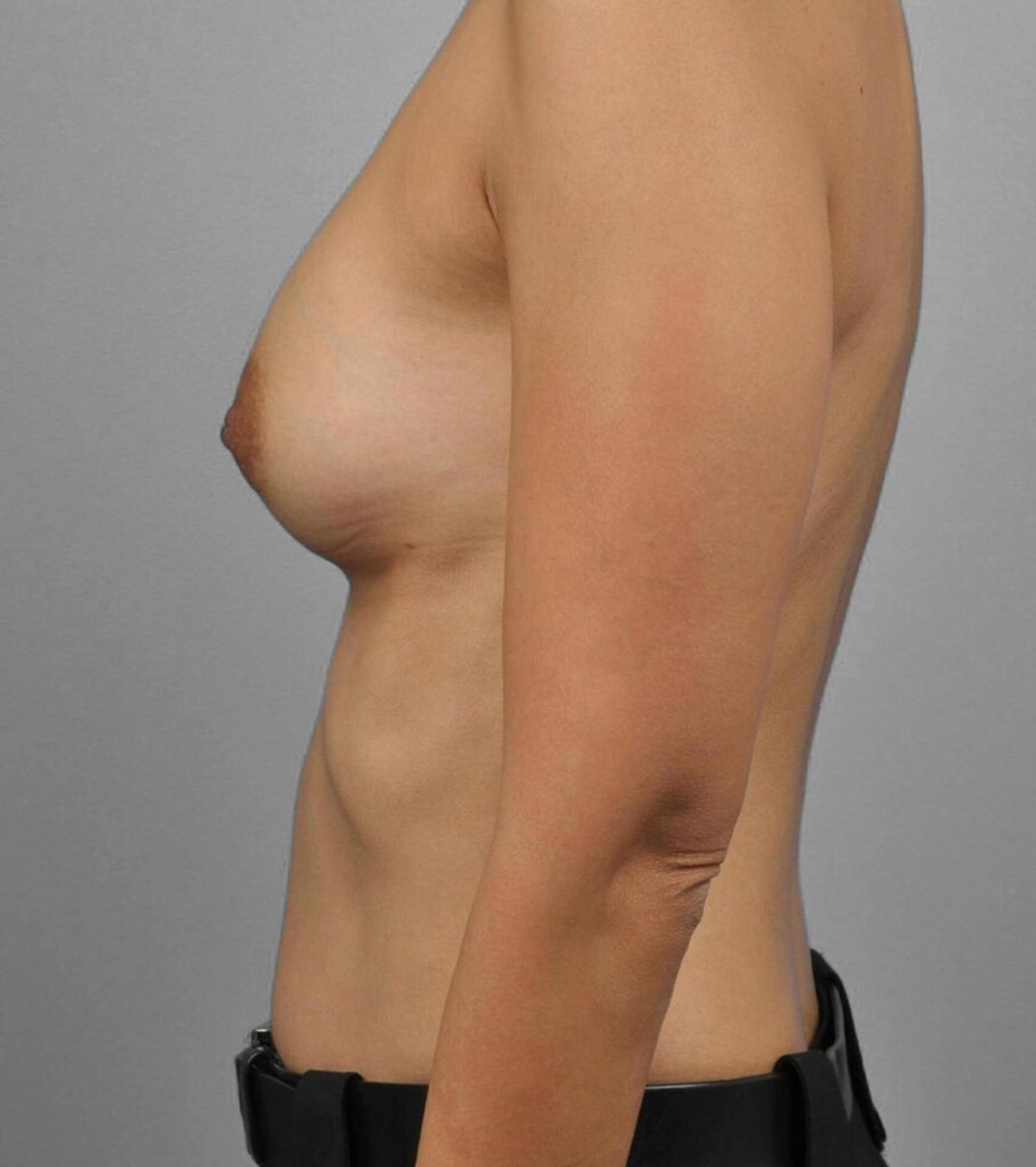 Case 1338 — Oblique before