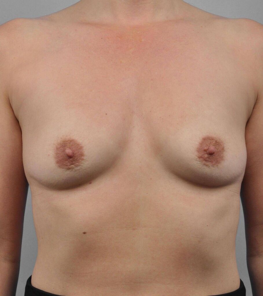 Before — Breast Augmentation