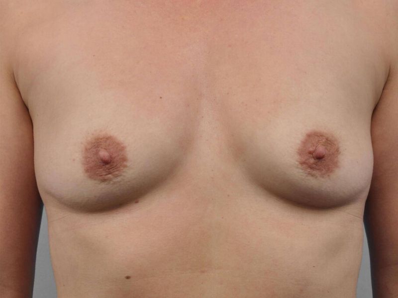 Before — Breast Augmentation