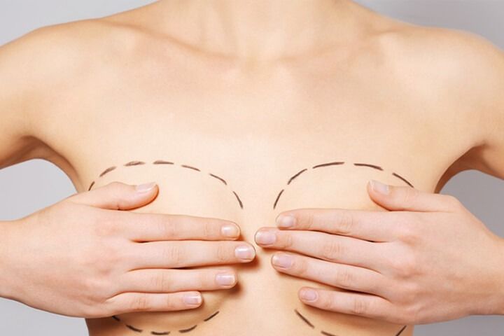 Breast Implant Revision – Is Capsule Removal Necessary?