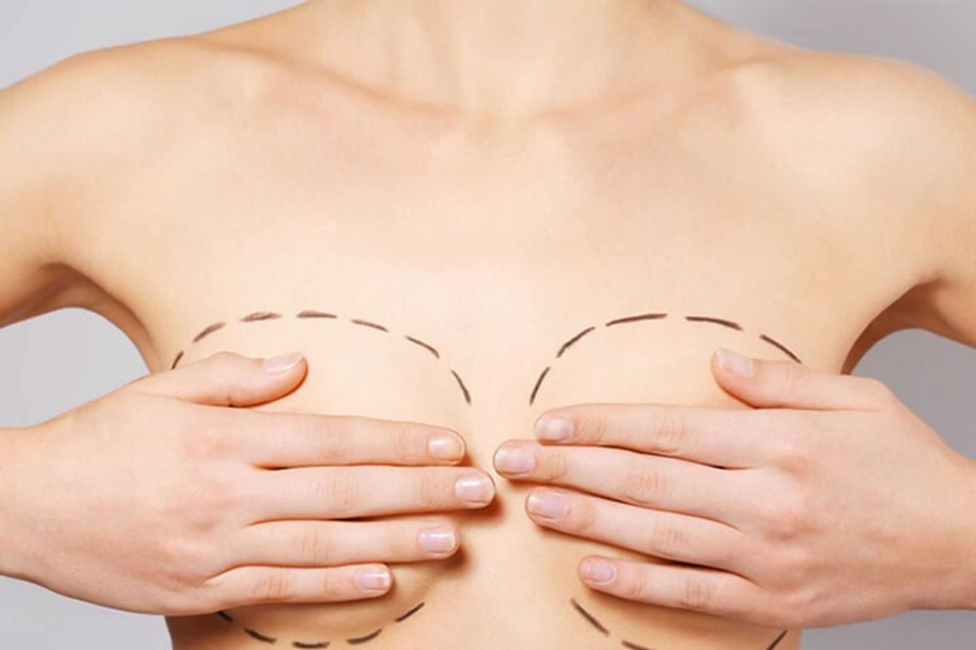 Breast Implant Revision – Is Capsule Removal Necessary?