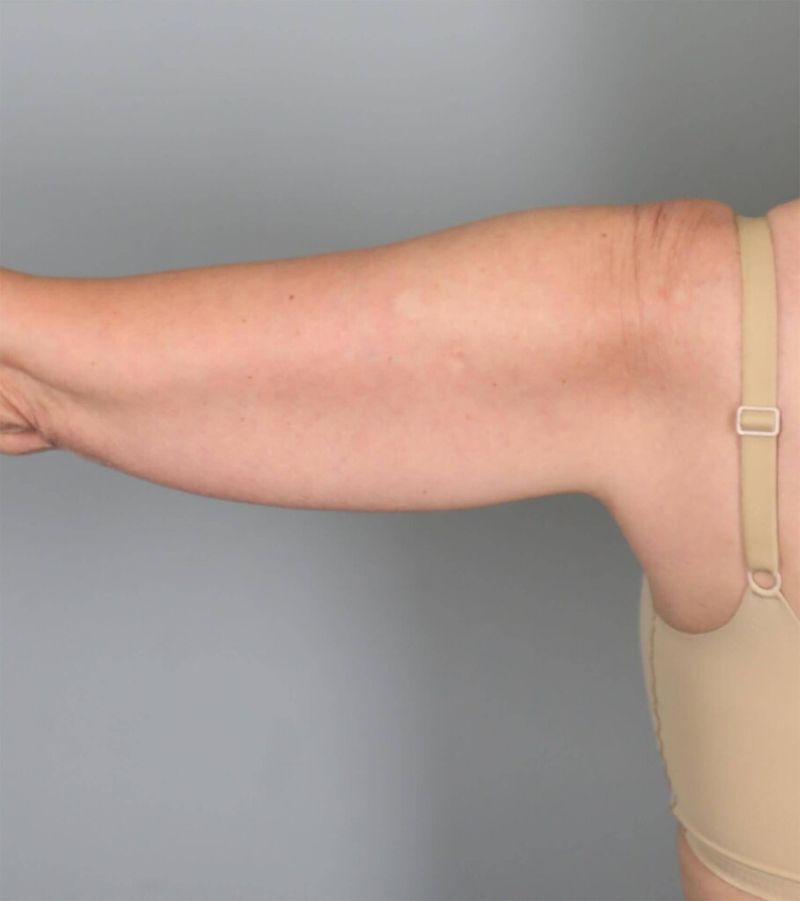 Before — Liposuction