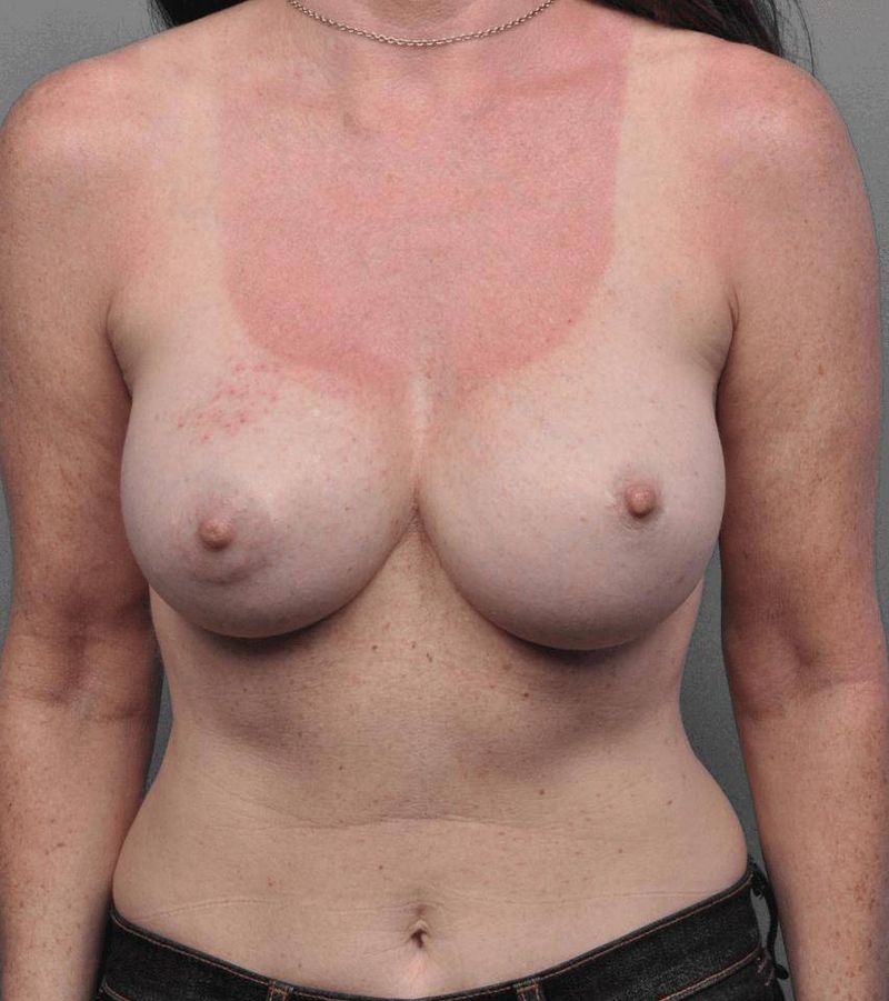 After — Breast Implant Replacement