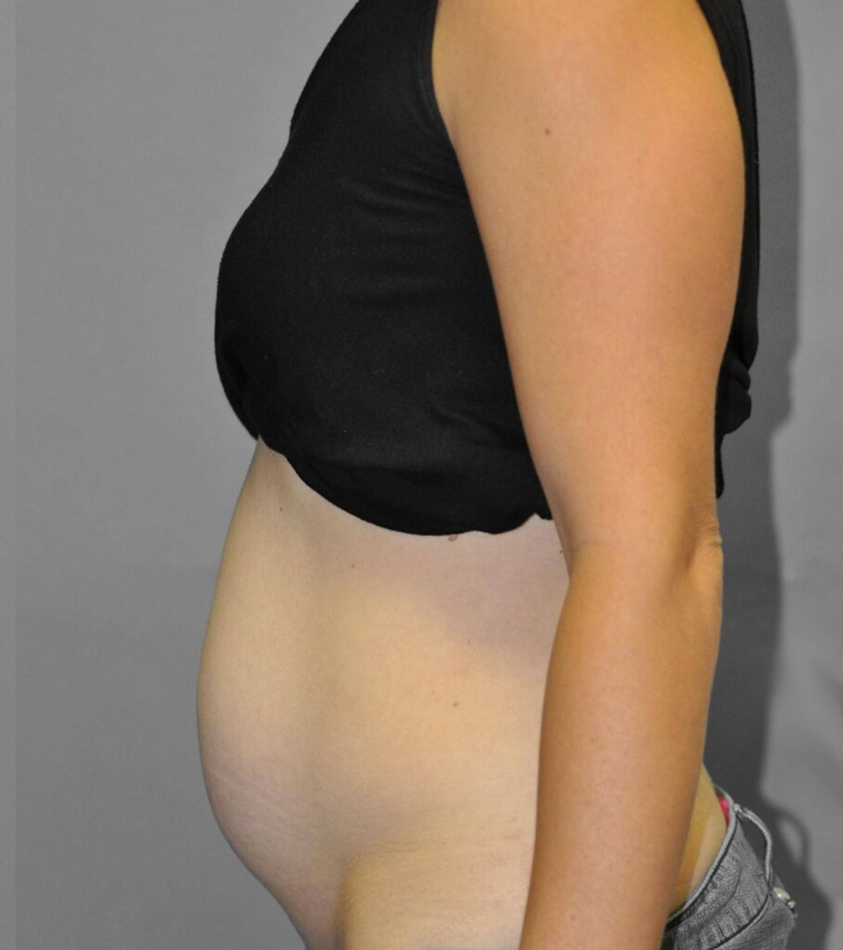 Case 1695 — Oblique before