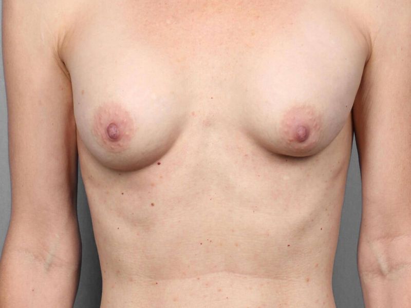 Before — Breast Reconstruction Revision
