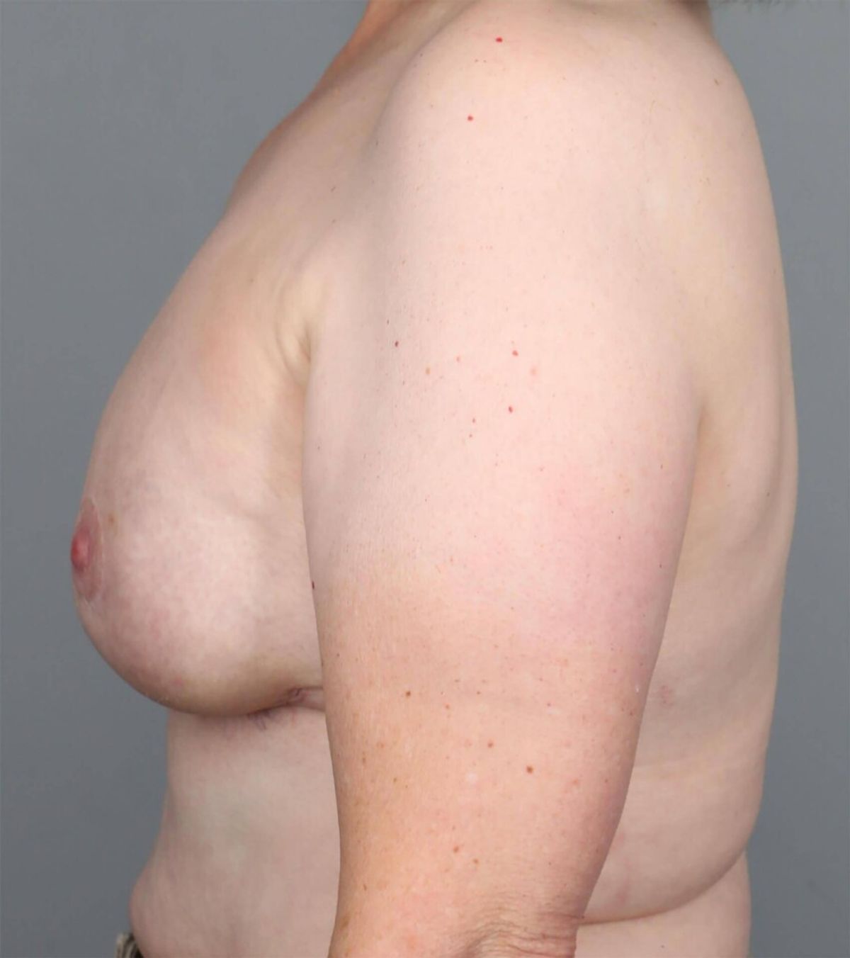 Case 1316 — Oblique after