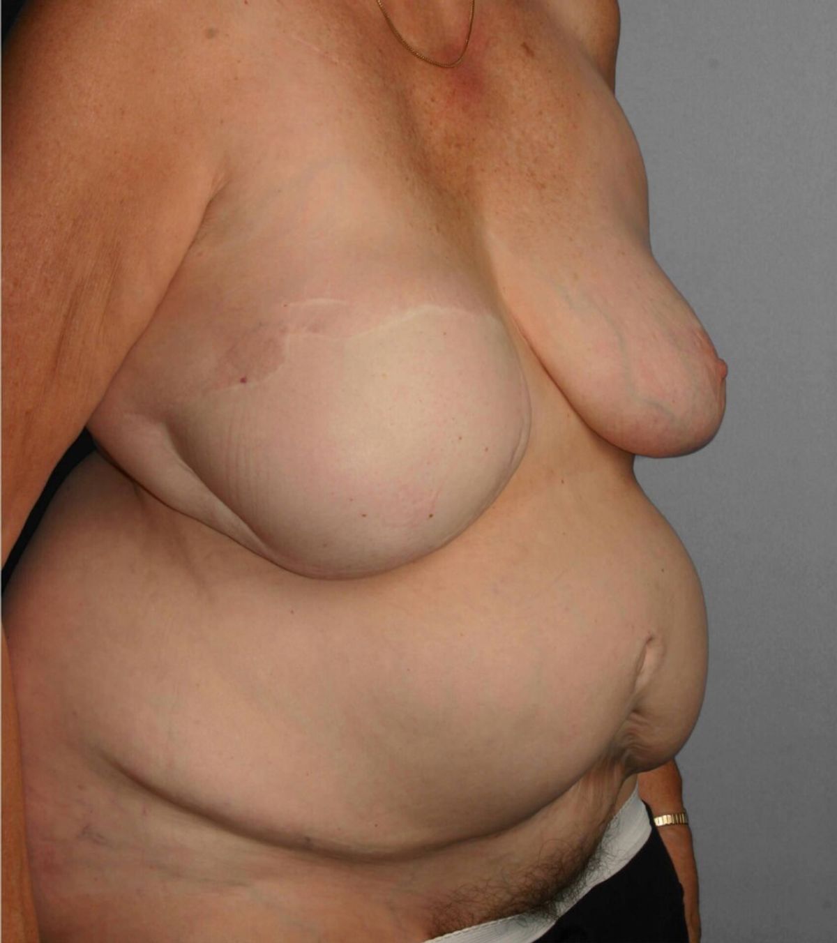 Case 1395 — Oblique before