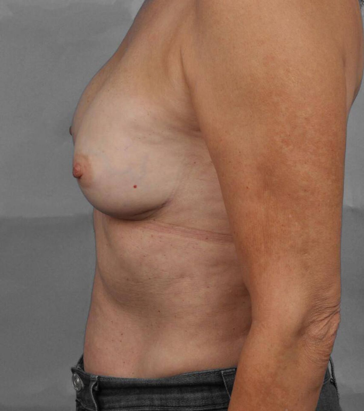 Case 1572 — Oblique before