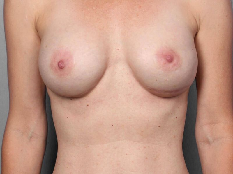 After — Breast Reconstruction Revision