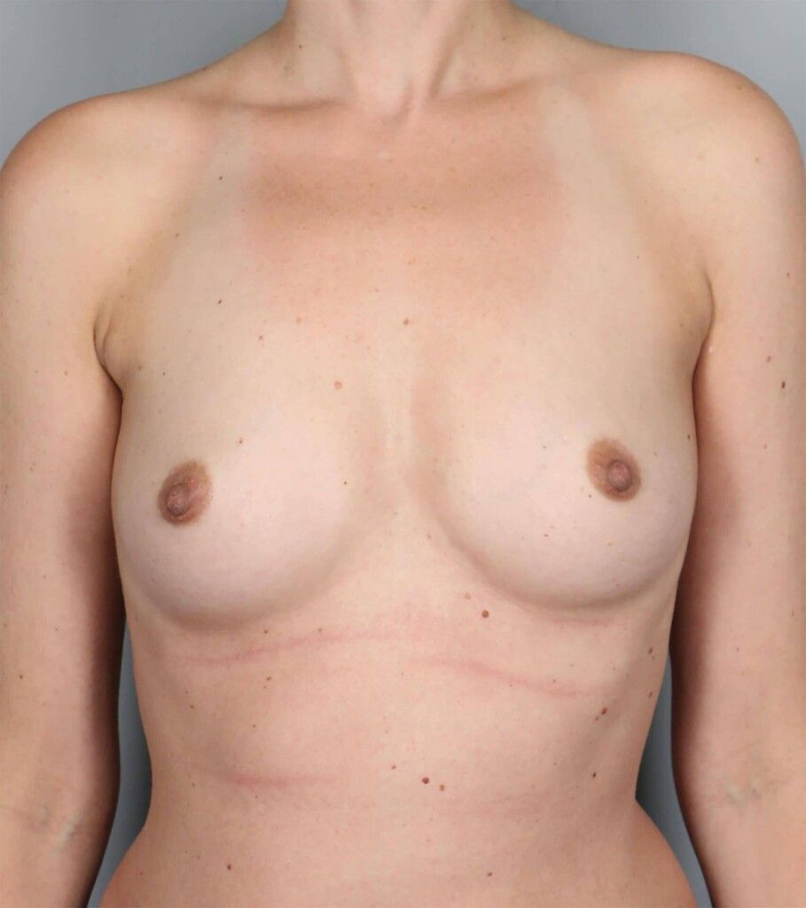 Before — Direct-to-Implant Reconstruction