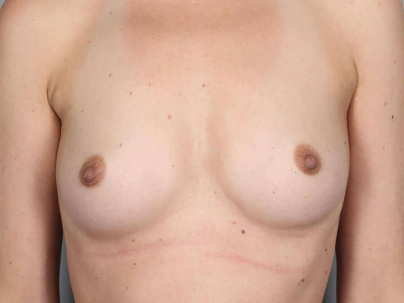Before — Direct-to-Implant Reconstruction