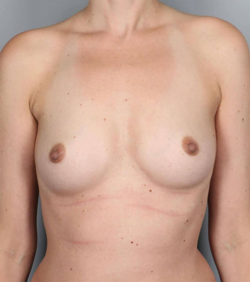 Before — Direct-to-Implant Reconstruction