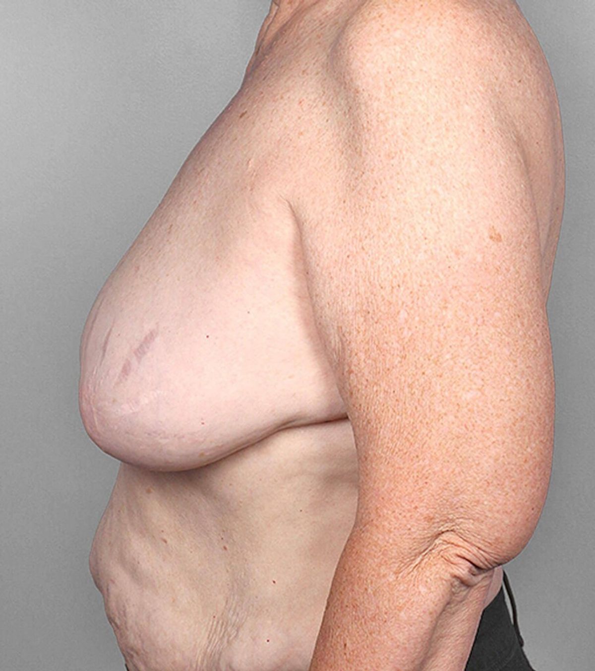 Case 1388 — Oblique before