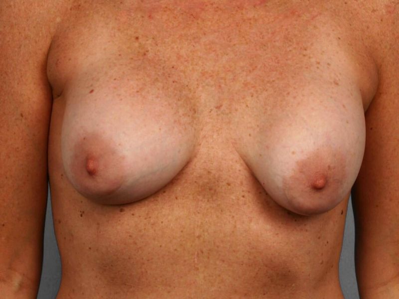 Before — Breast Reconstruction Revision