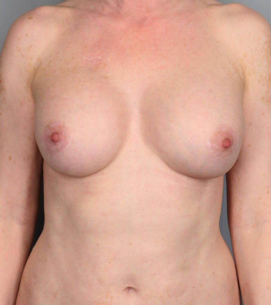 After — Fat Transfer Breast Augmentation