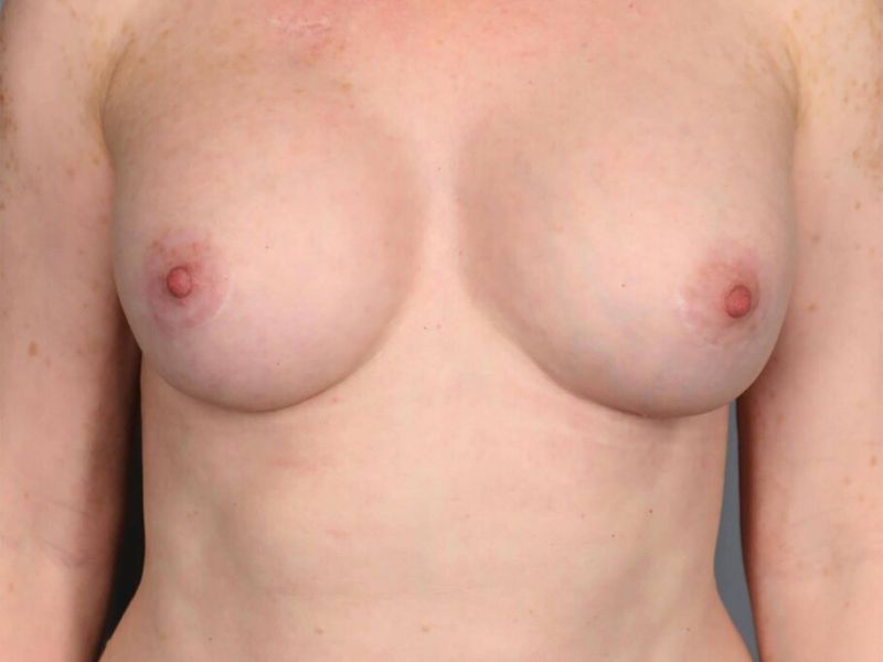 After — Fat Transfer Breast Augmentation