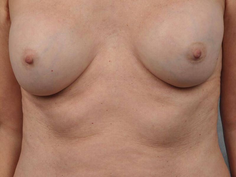 After — Breast Implant Replacement