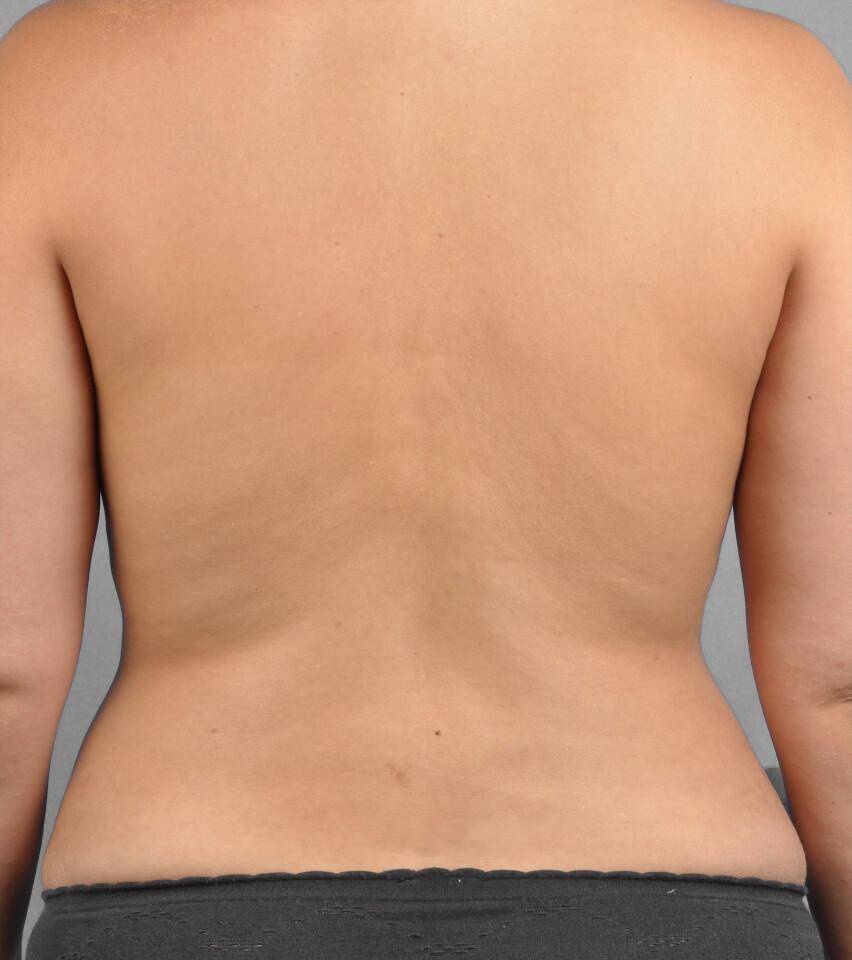 After — Liposuction