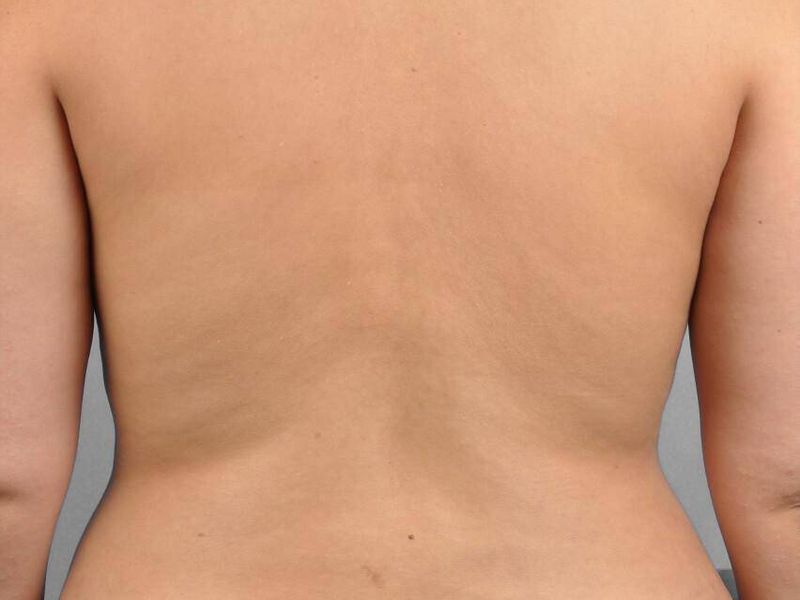 After — Liposuction