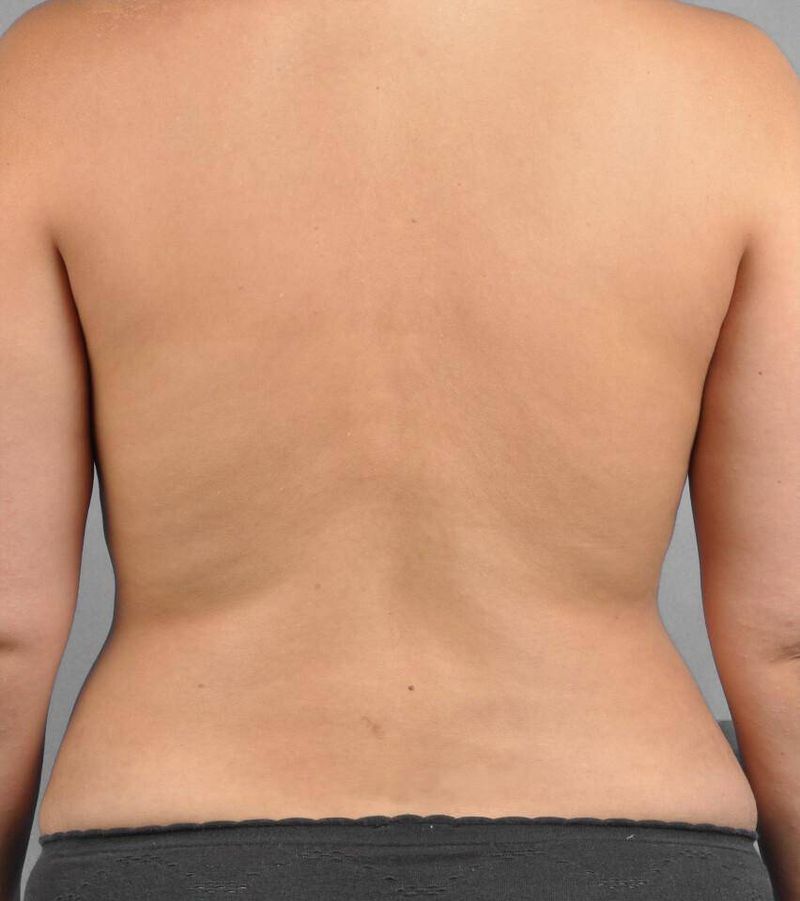 After — Liposuction