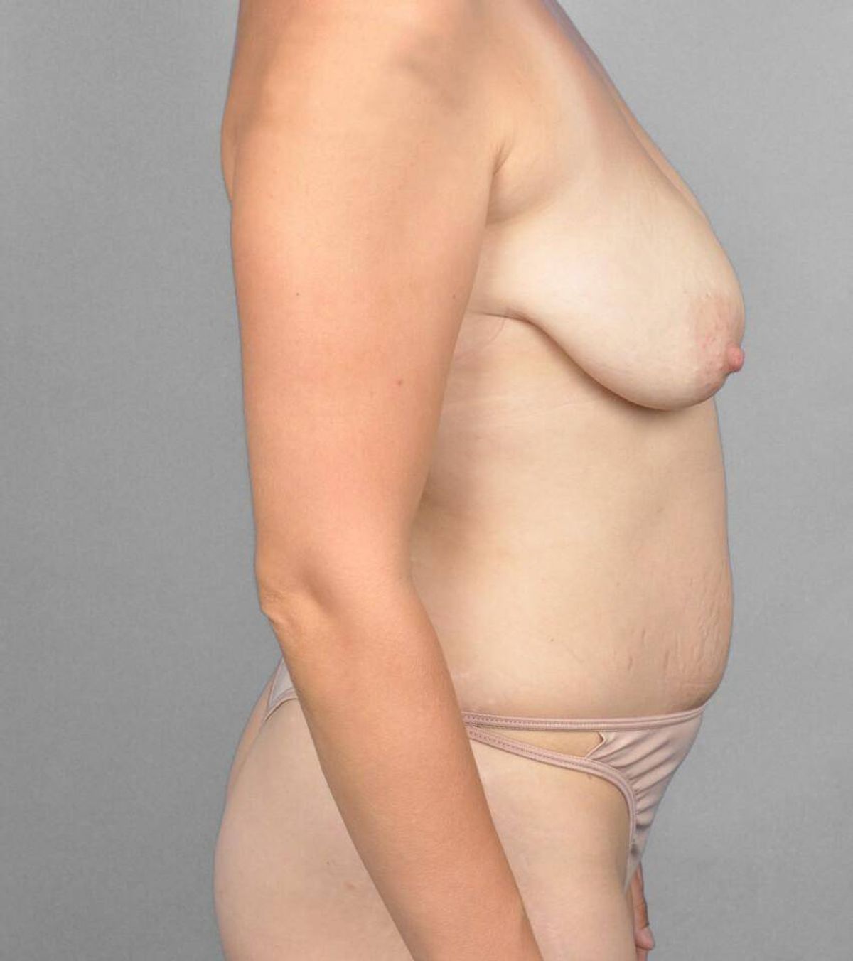 Case 1483 — Oblique before